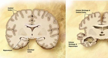 Why you should not ignore decreased mental agility, as you age?