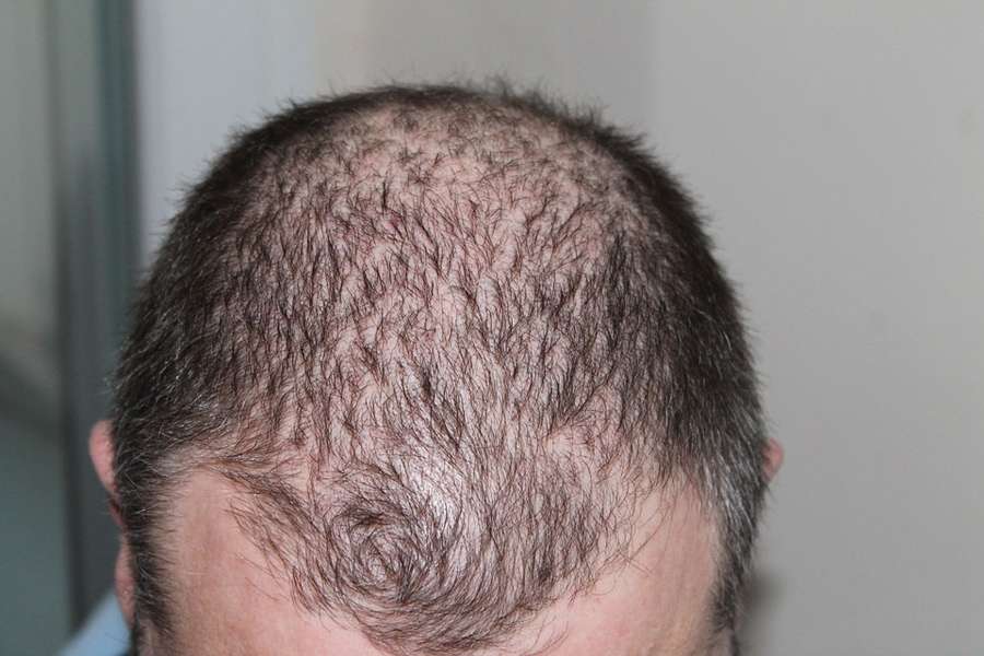 Do Not Lose Your Head, Trying To Find Hair Loss Solutions - Hair Transplant And Other Options 