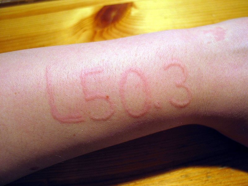 Dermatographic urticaria