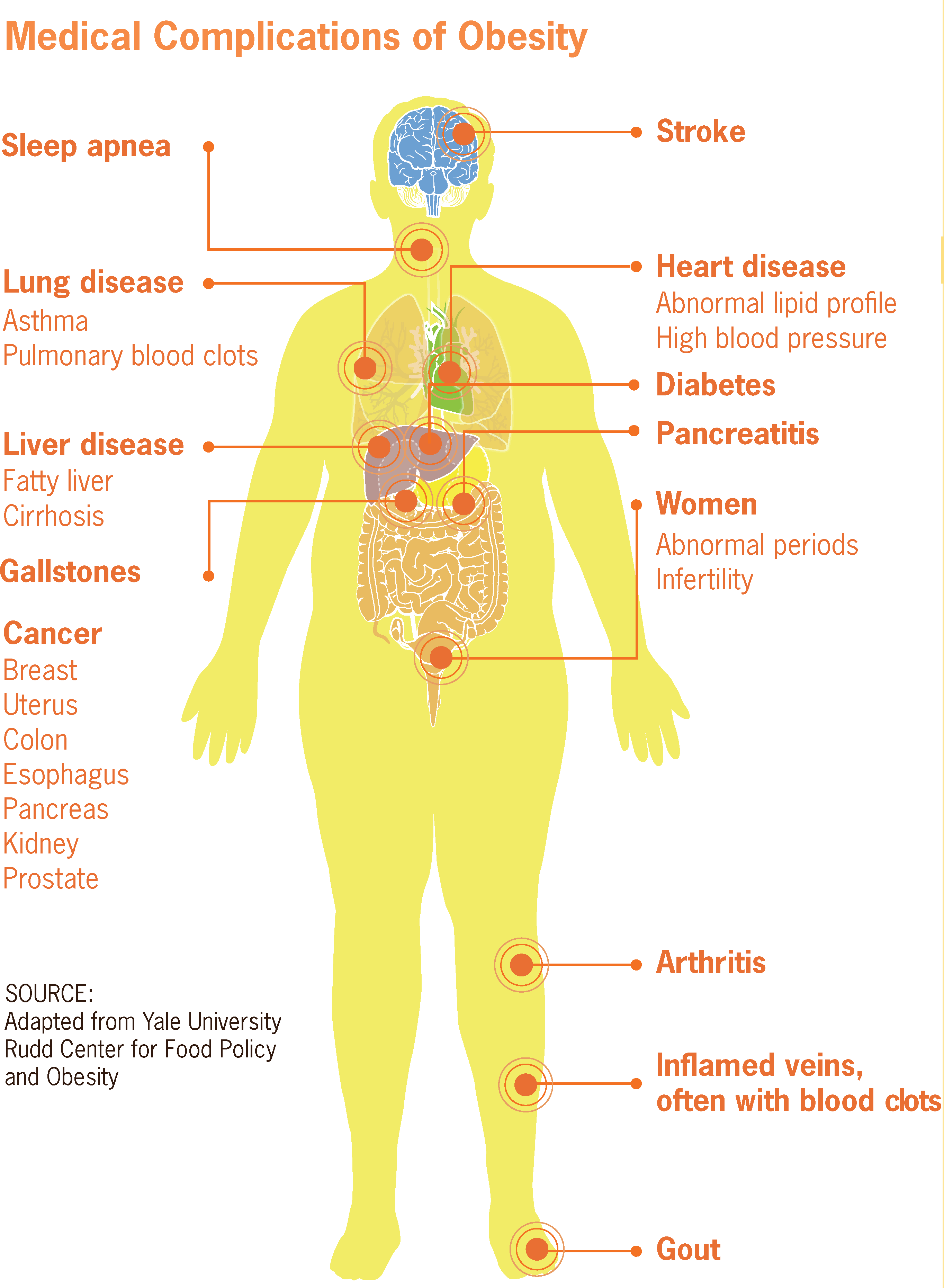 Medical complications of obesity