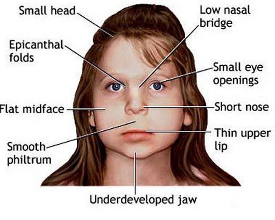 Foetal Alcohol Syndrome