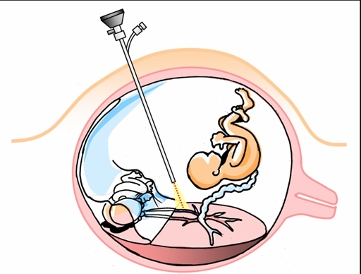 Endoscopic Foetal Surgery for twin to twin transfusion syndrome