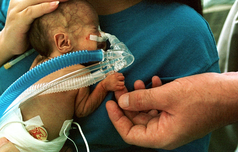 Premature infant in CPAP