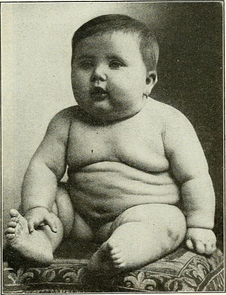 Gynaecomastia can be seen in infancy