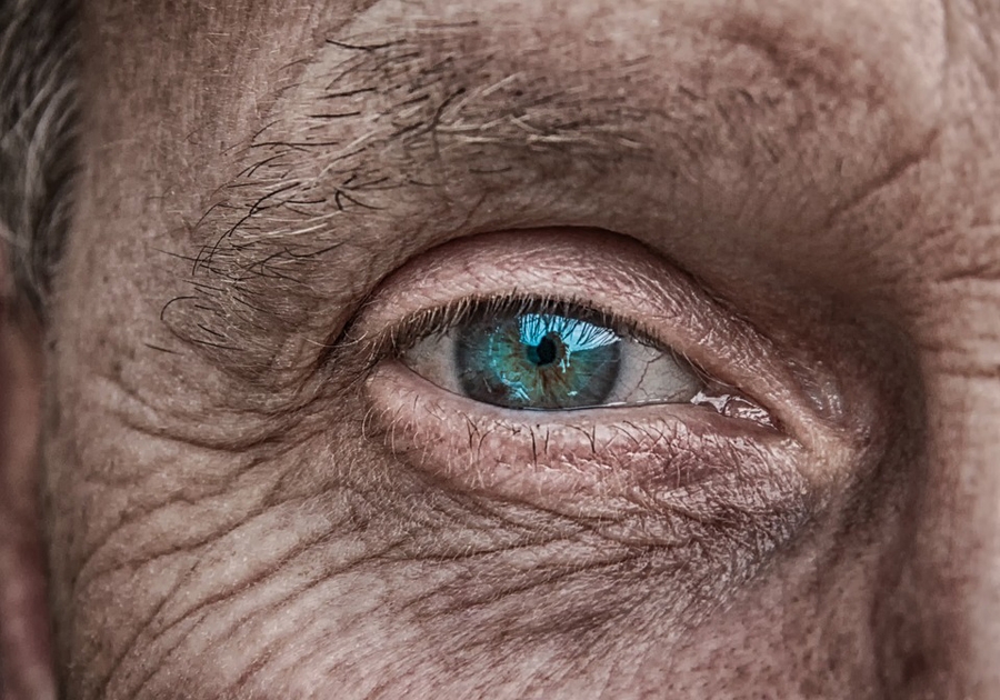 Age related changes of eyelids, benefit from Blepharoplasty