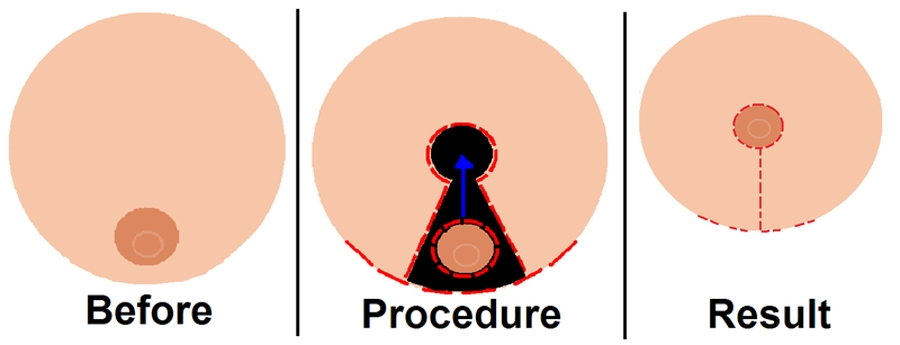 Diagram showing procedure of  Breast reduction surgery.