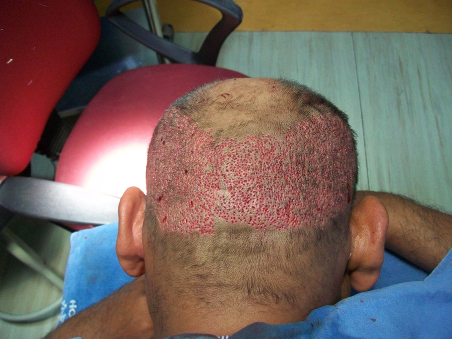 The donor site after harvesting graft by FUE method