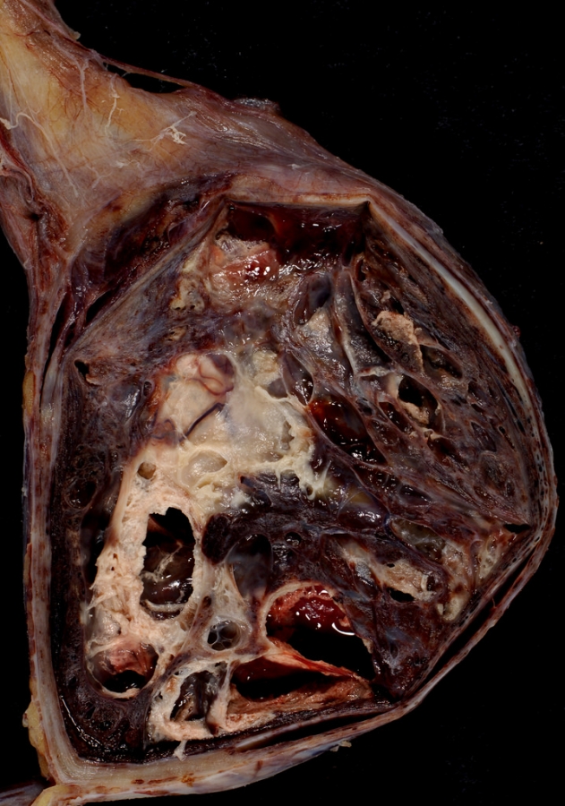 Mixed Germ Cell Tumour of Testis can cause Gynaecomastia