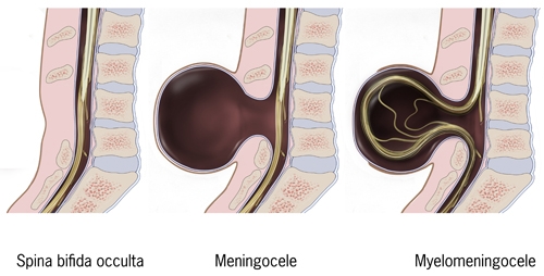 Diagramatic representation of Myelomeningocele