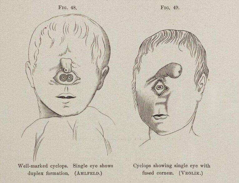 Illustration of Cyclopia, 1893.