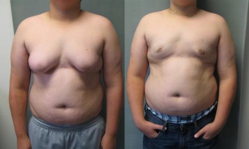 Gynecomasta - Before and after treatment images