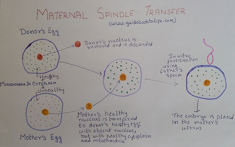 A simplified diagram of maternal spindle transfer technique.