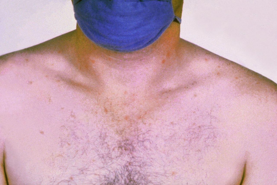 Rose spots on the chest of a patient with typhoid fever due to the bacterium Salmonella typhi.