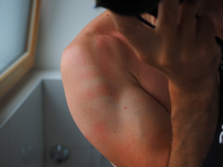 Sunburns can increase a person's  risk of melanoma.