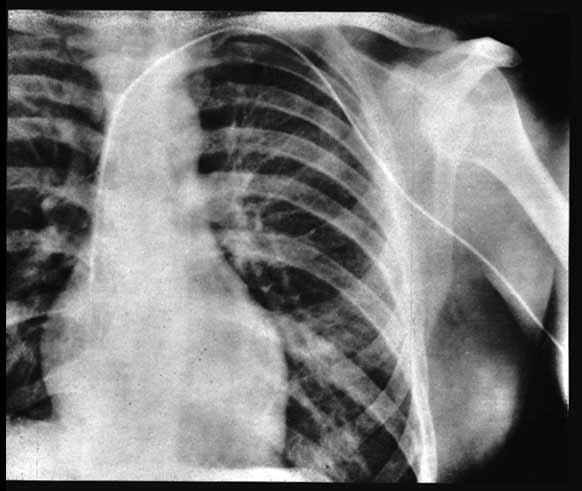X-ray of Werner Forssmann