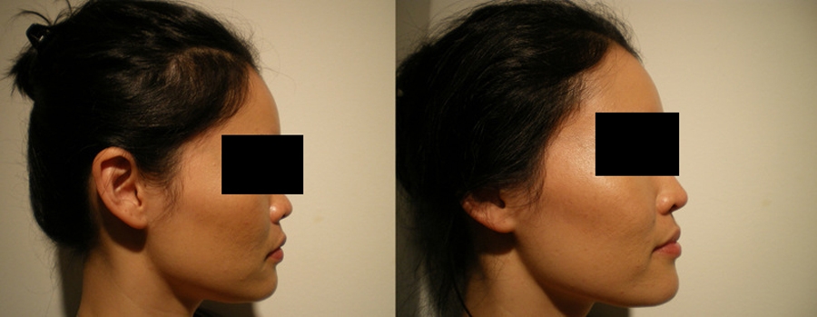 Effect of filler injection in Nose