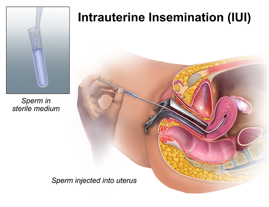 Procedure of Intrauterine Insemination