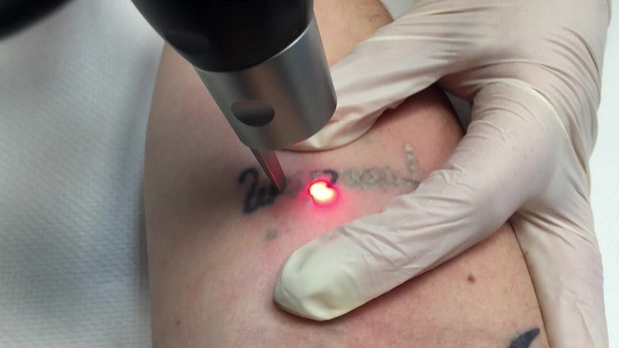 Tattoo removal by Laser
