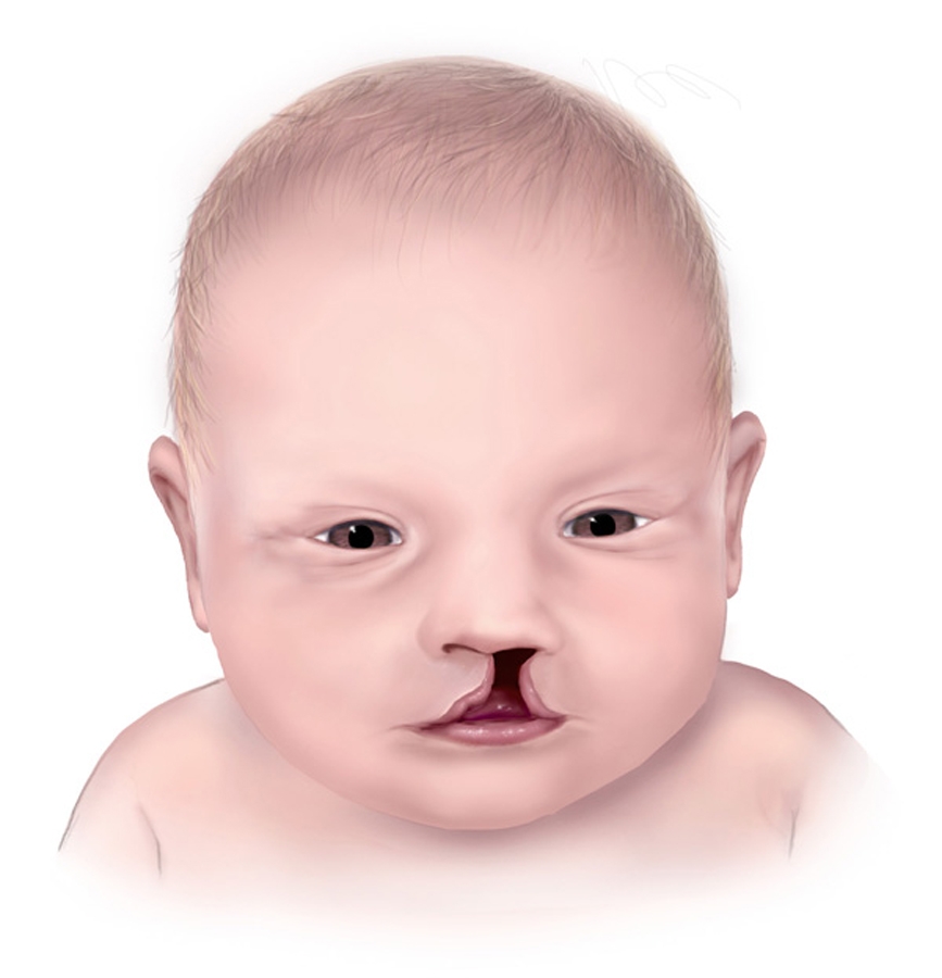 Cleft deformity is seen commonly in babies of mothers on anti epileptic drug