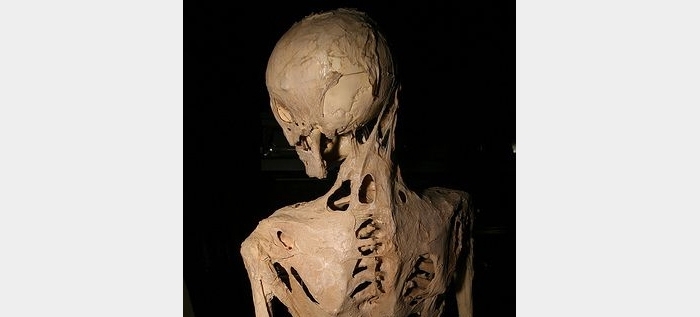 Fibrodysplasia ossificans progressiva