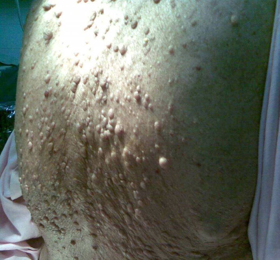 Back of an elderly woman with neurofibromatosis.