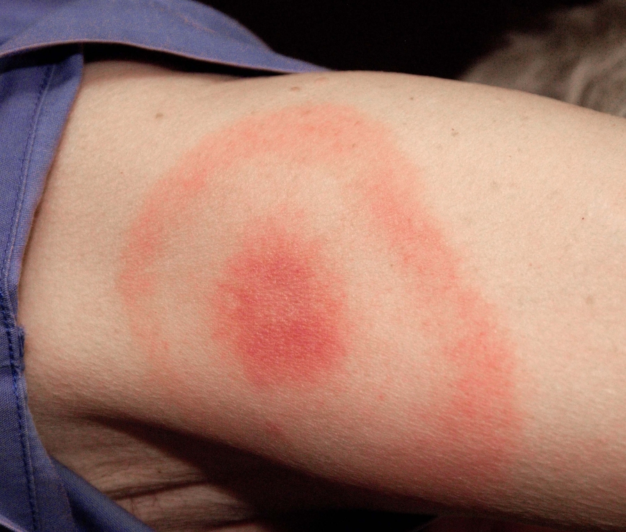 Erythema migrans - erythematous rash in Lyme disease.