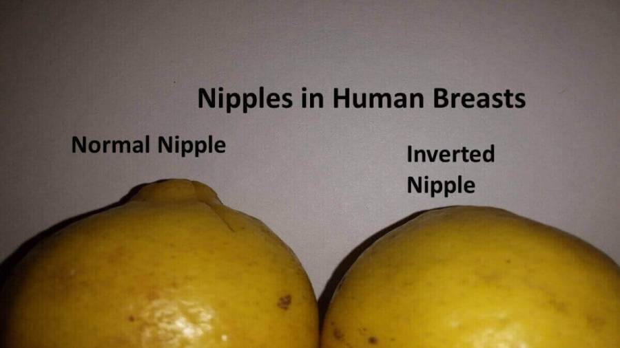 Symbolic representation of Inverted Nipples in Humans.