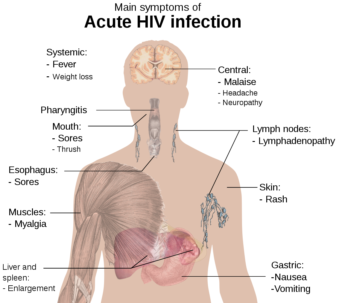 Symptoms of acute HIV infection