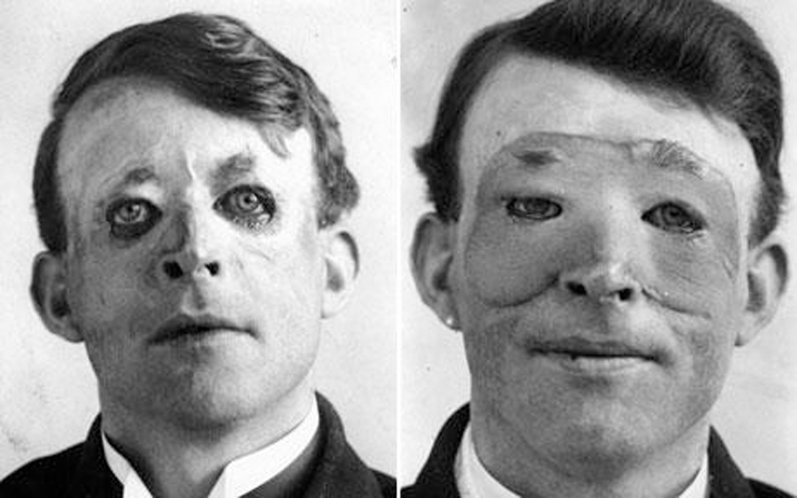 Walter Yeo, first person to receive Plastic Surgery in modern times in 1917, thus giving birth to a new academic subject.