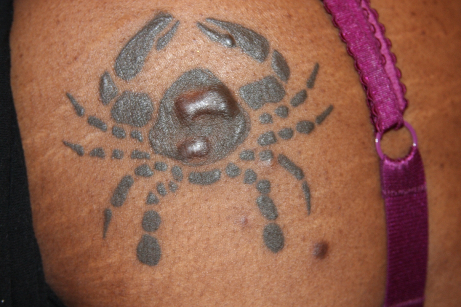 Keloid formation at the site of a tattoo