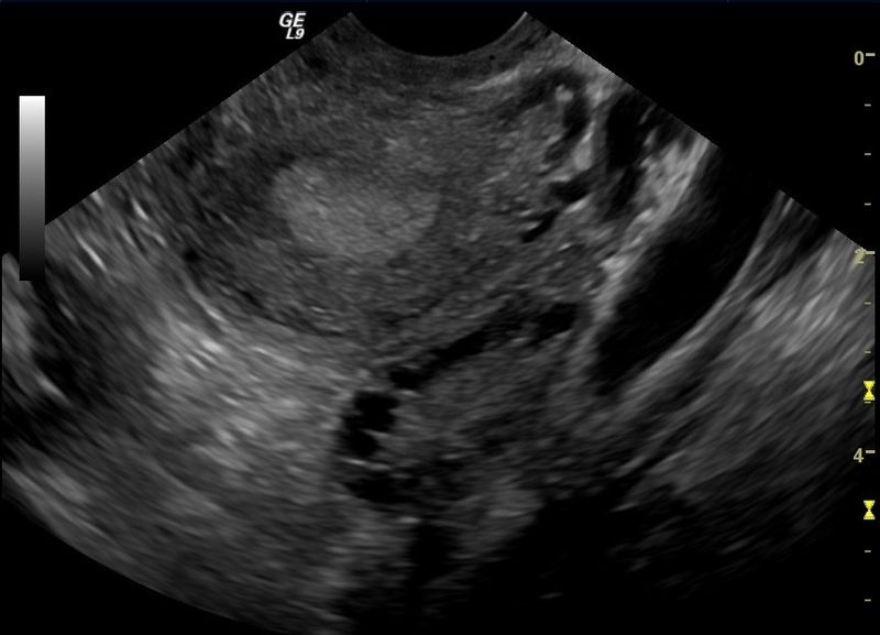 ultrasound scan of polycystic ovary