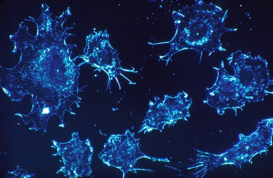 Rapid spread of cancer cells to distant organs, creates devastating effects.