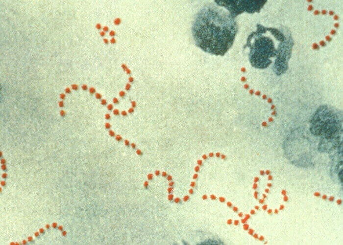 Streptococcus pyogenes (red-stained spheres) is responsible for most cases of severe puerperal fever.