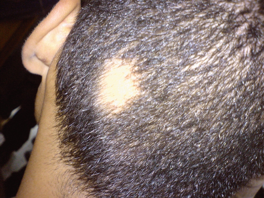 Allopecia areata