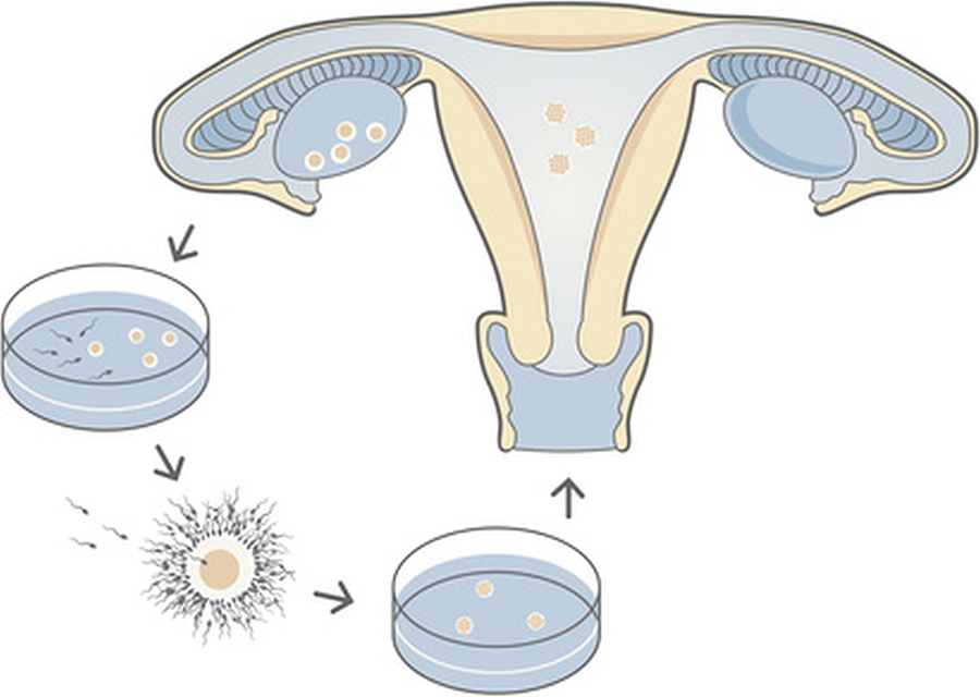 In-vitro fertilization (IVF) - Egg cells being fertilised by sperm outside of the womb