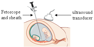 Fetoscopy