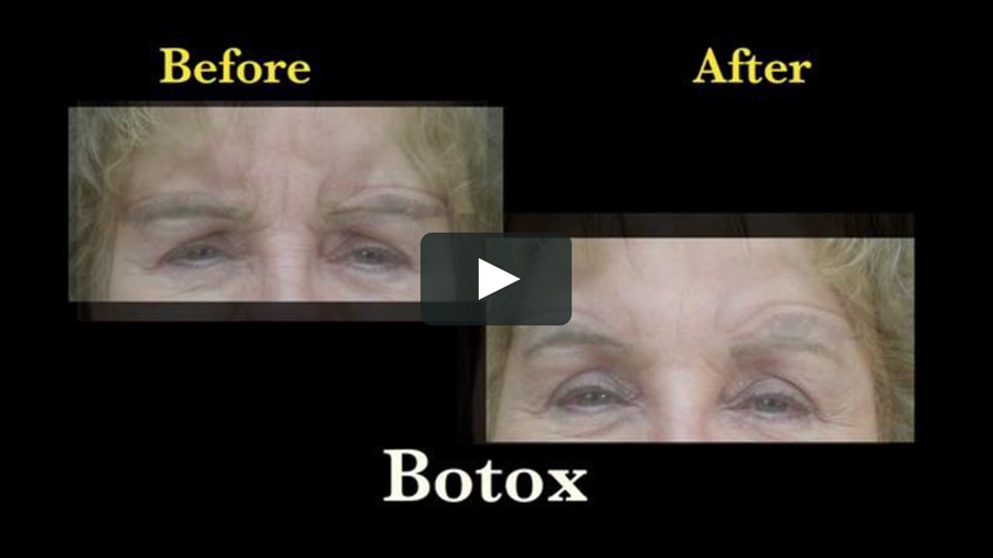 Botox Results