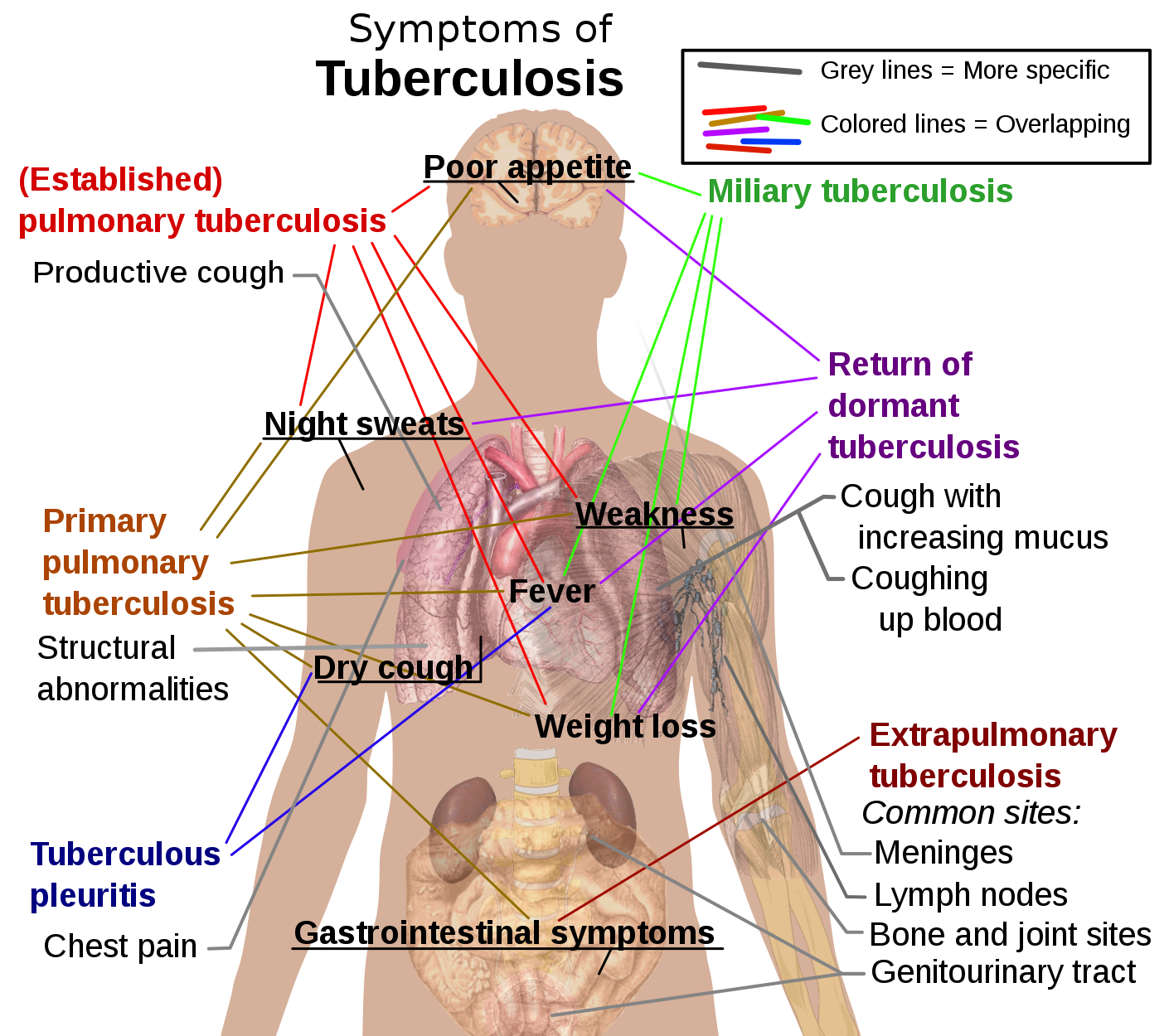 Main symptoms of different variants of tuberculosis.